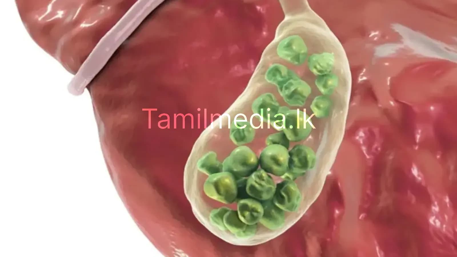 பித்தப்பை கற்களை போக்கும் ஆரோக்கியமான உணவுகள்