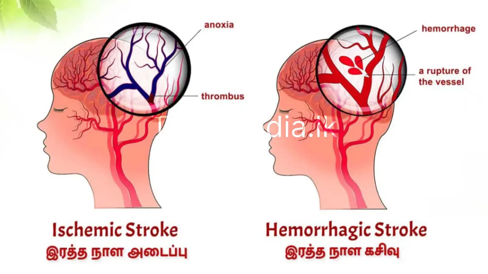 மூளைப் பக்கவாதத்தால் அதிகரிக்கும் உயிரிழப்பு