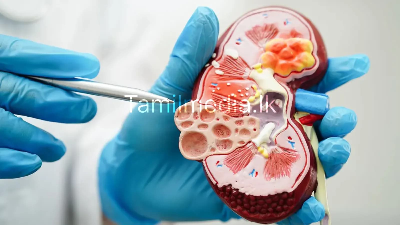 இலங்கையில் நாள்தோறும் 5 பேர் சிறுநீரக நோயால் உயிரிழப்பு